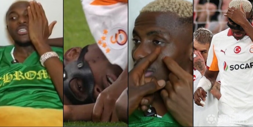 奥斯梅恩：我脸上现在还有18颗螺钉，右侧甚至无法正常进食